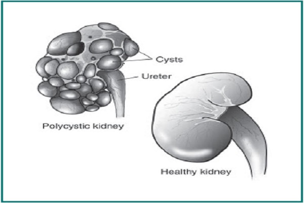 ALBUMINURIA